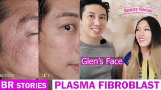 What is Plasma Fibroblast Skin Tightening Treatment in detail [upl. by Bible]