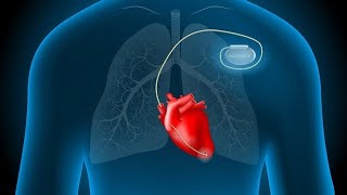 Placement of a pacemaker on the patients ♥ [upl. by Notnil]