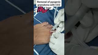 Removal of pyogenic granuloma with CO2 laser [upl. by Estey]