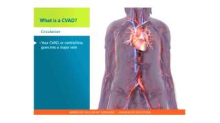 Central Lines Skills What is a CVAD [upl. by Sansbury]