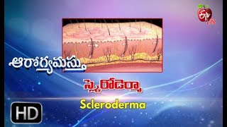 Aarogyamastu  Scleroderma  29th June 2017  ఆరోగ్యమస్తు [upl. by Adym]