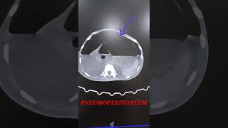 Pneumoperitoneum CT Abdomen pelvisRadiology Learning [upl. by Kryska]