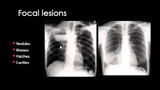 Chest XRay CXR in Arabic  Prof Mamdouh Mahfouz [upl. by Tracy]