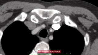 Mediastinal Cross Sectional Anatomy on CT DISCUSSION by Radiologist [upl. by Hajin]