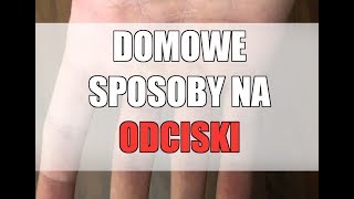 ODCISKI „NAGNIOTKI” – DOMOWE SPOSOBY [upl. by Stanly]