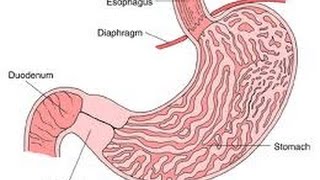 Pyloric Stenosis [upl. by Eselehs]