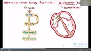 AVRT and AVNRT [upl. by Blancha]