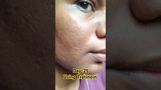 Day25 Using Tretinoin 0025 cream skincare tretinoin viralvideo shorts youtubeshorts [upl. by Atilrep]