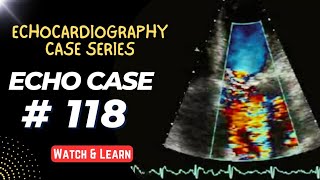 ECHO CASE 118  Echocardiography For Beginners  Echo Cases [upl. by Sila]