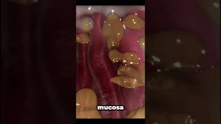 helicobacter pylori infection [upl. by Adikam]