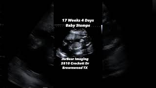 17 Weeks 4 Days Ultrasound jerbearimaging babykicks babyinthewomb sono [upl. by Petie]