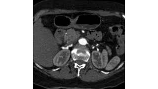 Fibromuscular Dysplasia [upl. by Flori414]