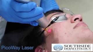 PicoWay Laser Treatment for Acne Scars amp Dark Spots [upl. by Kuster]