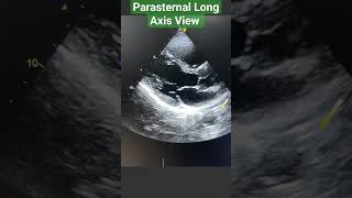 Parasternal Long Axis View Echo l Echocardiography l Shorts youtubeshorts [upl. by Hadihahs745]