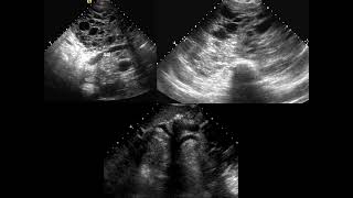 Chest FRCR2b CASES [upl. by Galatea]