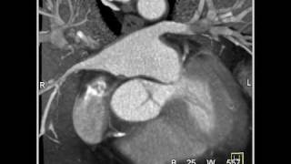 Cardiac Coronary CT Anatomy 1 of 2 [upl. by Rebak611]