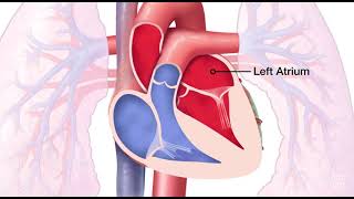 Mitral Valve Regurgitation [upl. by Swerdna]