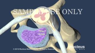 Cervical Disc Herniation [upl. by Tammara]