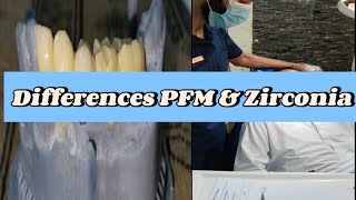 Difference porcelain amp Zirconia CrownPFM Crown CementationPorcelain Crowns Front teethPFM [upl. by Siusan680]