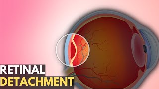 Retinal Detachment Everything You Need To Know [upl. by Emarej578]