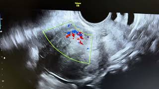 Focal adenomyosis in asymptomatic patient [upl. by Nertie878]