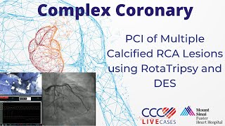 Watch Live PCI of Multiple Calcified RCA Lesions using RotaTripsy and DES [upl. by Wall]