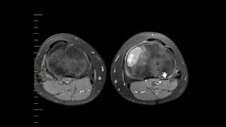 Aneurysmal Bone Cyst [upl. by Akined]