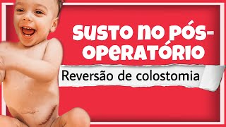 Reversão de colostomia e susto no pós operatório do Lucca [upl. by Ecirpac]