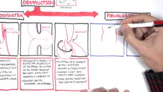 Bowel Obstruction  Causes and Pathophysiology [upl. by Betz591]