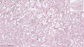 Pneumocystis Jirovecii Pneumonia  Histopathology [upl. by Silvanus]