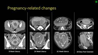 Gynecologic Radiology Anatomy [upl. by Norrie]