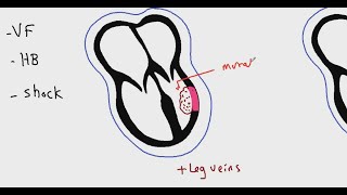 Systemic pathology 6  CVS  myocardial infarction  DRSAMEH GHAZY [upl. by Farrah]