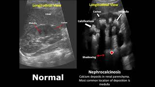 Kidney Ureter and Bladder KUB Ultrasound Normal Vs Abnormal Image Appearances Comparison [upl. by Maharba]