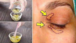 Xanthelasma removal at home  Home remedy to get rid of cholesterol deposits around your eyes natura [upl. by Llenoil]