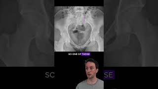 Sacral ala fracture with disruption of the arcuate lines radiology medicalstudent orthopedics [upl. by Ennaitsirhc]