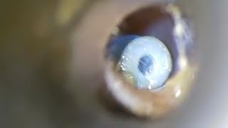 Gruesome Footages Shows Removal Of Ear Grommets [upl. by Philipson208]