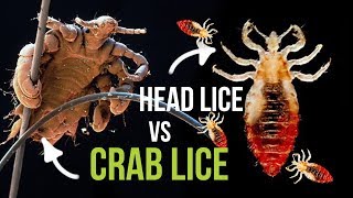 Crab Lice vs Head Lice  What is the Difference [upl. by Sivahc587]