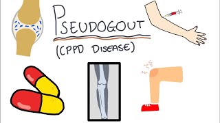 Pseudogout Calcium Pyrophosphate Disease  Simple and easy to understand [upl. by Tayler]