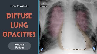 How to assess Diffuse Lung Opacities  Reticular pattern  Lec 13 [upl. by Hizar]