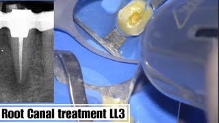 Root canal treatment Lower left 3 step by step [upl. by Submuloc189]