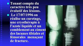 Hémangioendothéliome épithélioïde multifocal du membre inférieur [upl. by Nerrad]