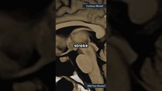 Recognizing the Warning Signs of a Stroke A LifeSaving Guide [upl. by Yeltneb]