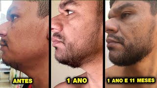 ELE USOU 5 TIPOS DE MINOXIDIL Kirkland Foligain Pant Kirkland em espuma e Minoxidil em cápsulas [upl. by Naibaf817]