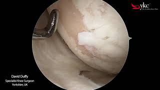 What Does Arthritis of The Knee Joint Look Like [upl. by Monjo]