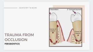 TRAUMA FROM OCCLUSION [upl. by Madalena]