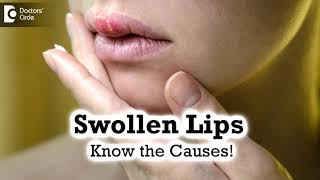 Swollen Lips Common CausesTriggers  Angioedema  Dr Rashmi Ravindra  Doctors Circle [upl. by Devan]