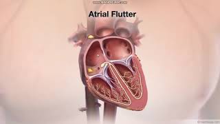 Atrial Flutter  mechanism  ecg features [upl. by Rhody]