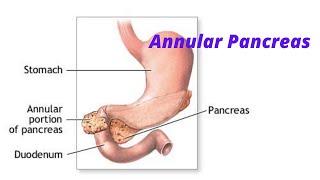 Annular Pancreas fmge neetpg usmle [upl. by Reginauld16]