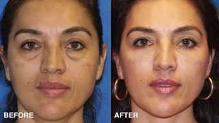 Facial Plastic Surgeon Explains How to Take 10 Years off your Eyes With Surgery blepharoplasty [upl. by Baxie457]