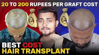 Cost Of Hair Transplant In India  Hair Transplant mein Kitna Kharcha Hota Hai [upl. by Einahpetse]